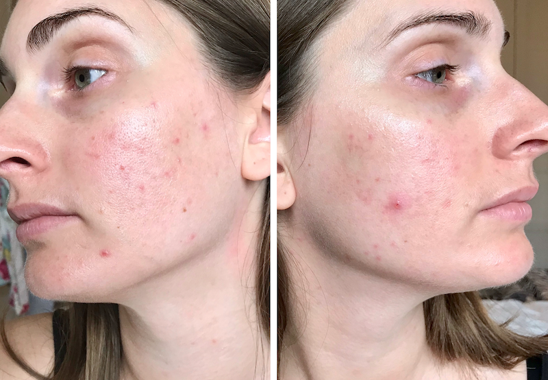 stoppen met de pil na 2 maanden, acne