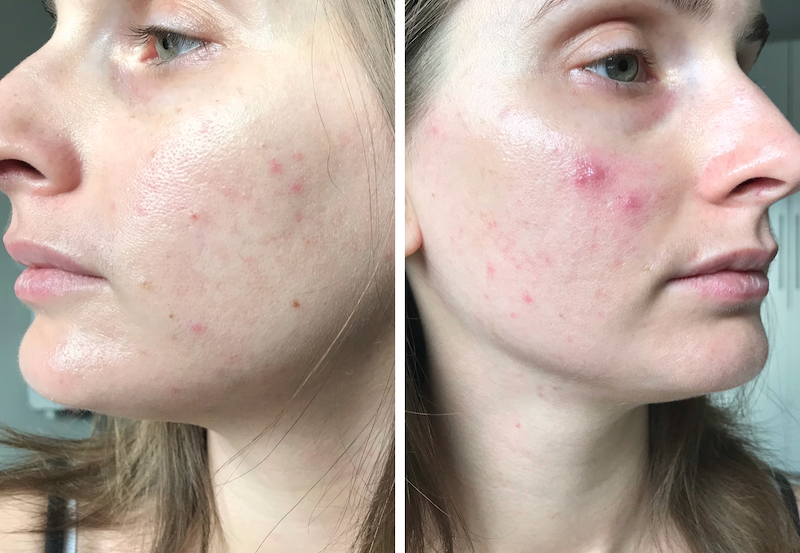 stoppen met de pil na 3 maanden, acne